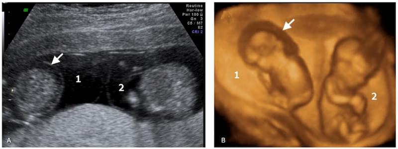 Двойня после переноса одного эмбриона